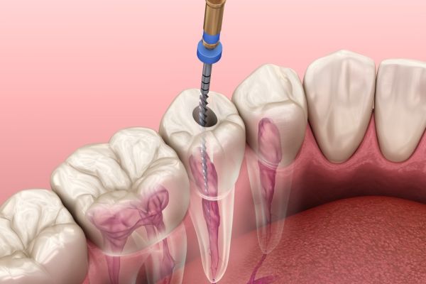 Endodoncja